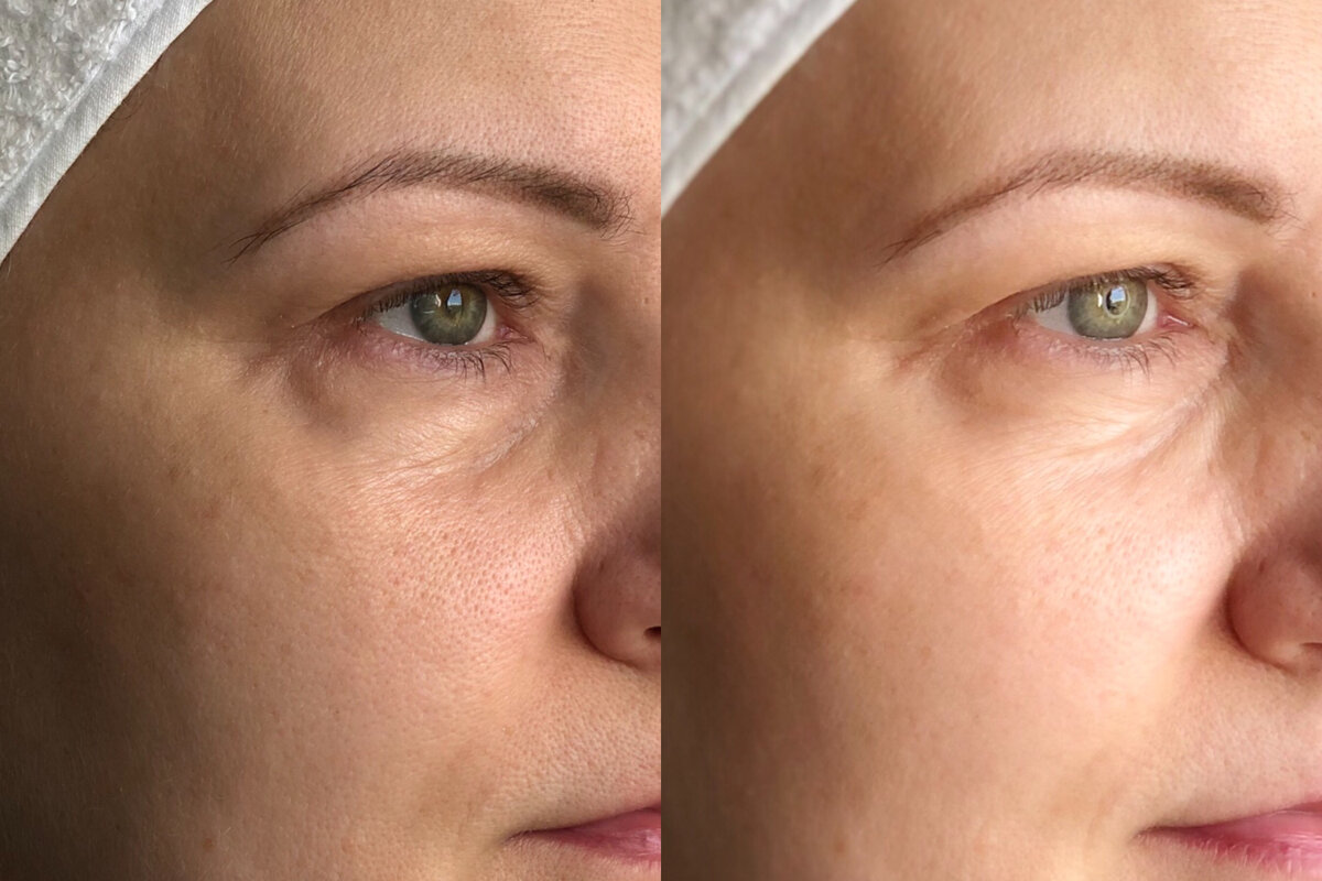 Результат до и после. Как сказала моя мама "и ботокс колоть не надо"