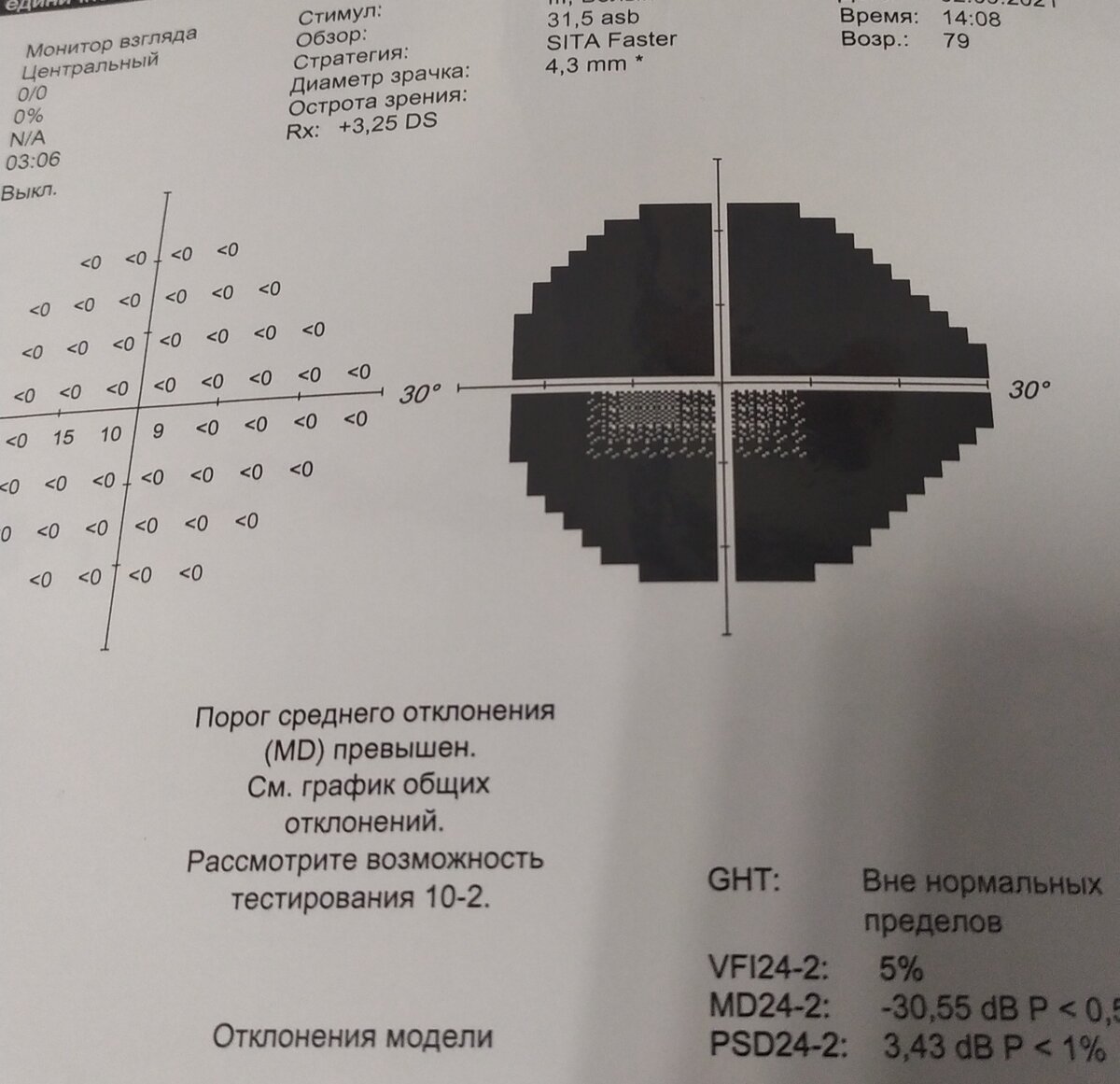 Поле зрение при далекозашедшей глаукоме - чёрная слепая зона с маленьким просветлением в центре. Называется "трубочное" поле зрение. 