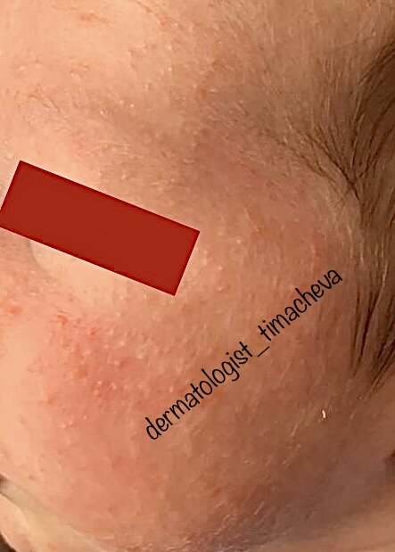 Фото из личного архива врача-дерматолога Тимачевой И.А. Неонатальные акне.