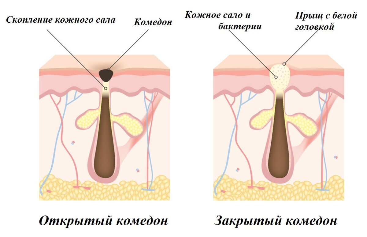 Самопомощь при акне: советы, как 