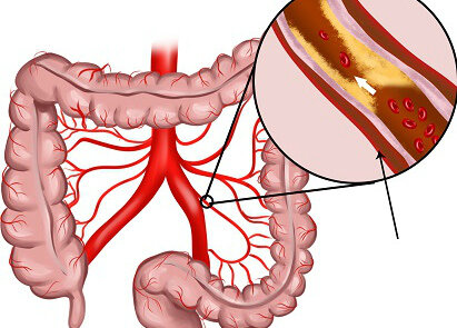 Первые симптомы атеросклероза сосудов кишечника