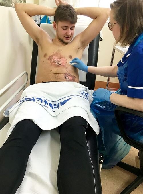 Уилл Хоксворт (24) показал, как он перенес ужасные ожоги на груди и животе, когда взорвались новые батареи на его Vape