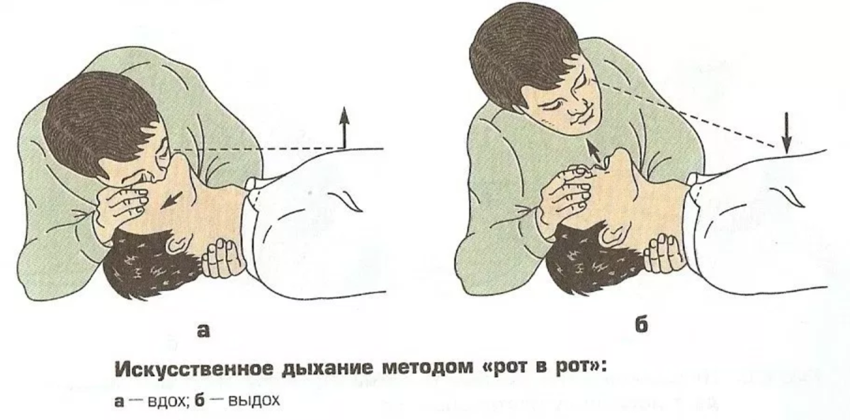 Искуственная вентиляция легких алгоритм кратко. Техника искусственного дыхания рот в нос. Искусственная вентиляция лëгких и непрямой массаж сердца. Алгоритм искусственного дыхания. Схема проведения искусственного дыхания.