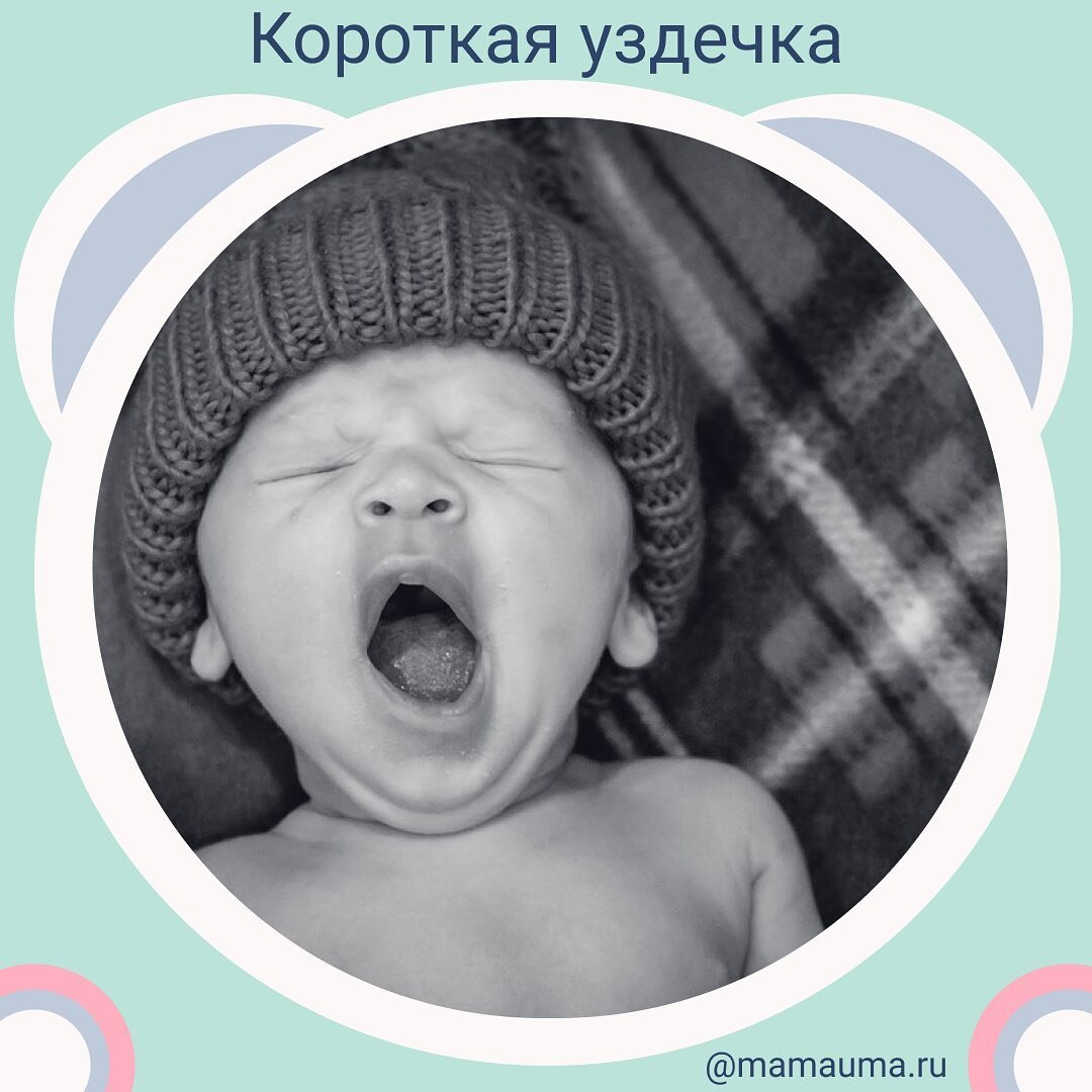 Укороченная подъязычная уздечка