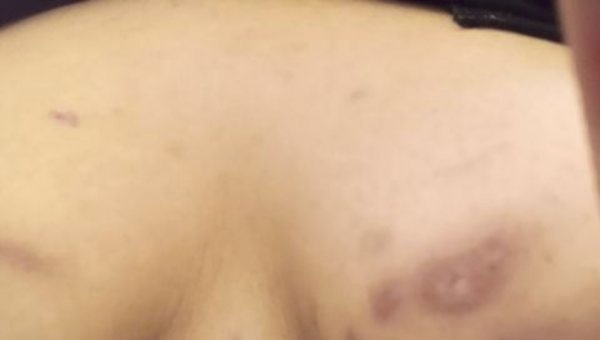 Наз утверждает, что призрак оставил ожоги на ее груди.