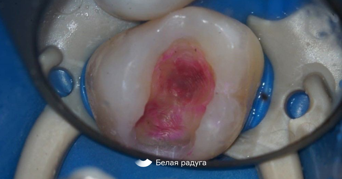 Использование кариес-детектора. В розовый цвет окрашены участки, пораженные кариесом
