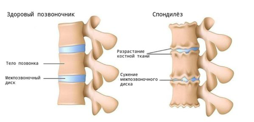 Межпозвоночный спондилез