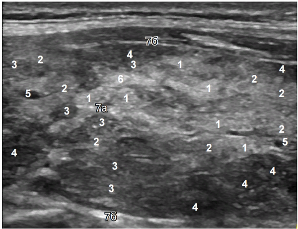 УЗИ-снимок щитовидной железы с обозначениями видов эхогенности