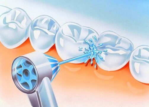 Источник: ozubkah.ru