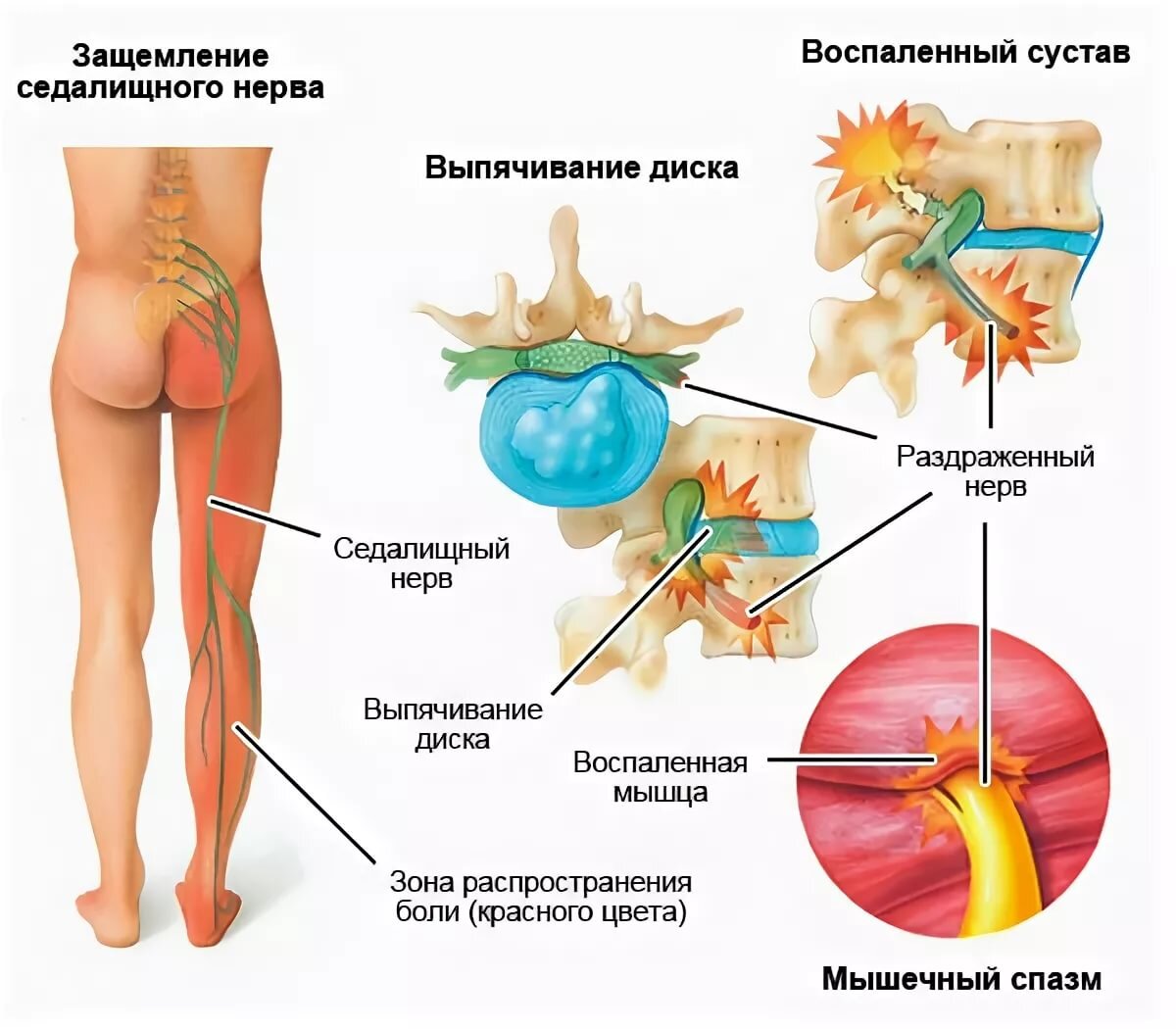 Грыжа межпозвонкового диска | Центр Дикуля