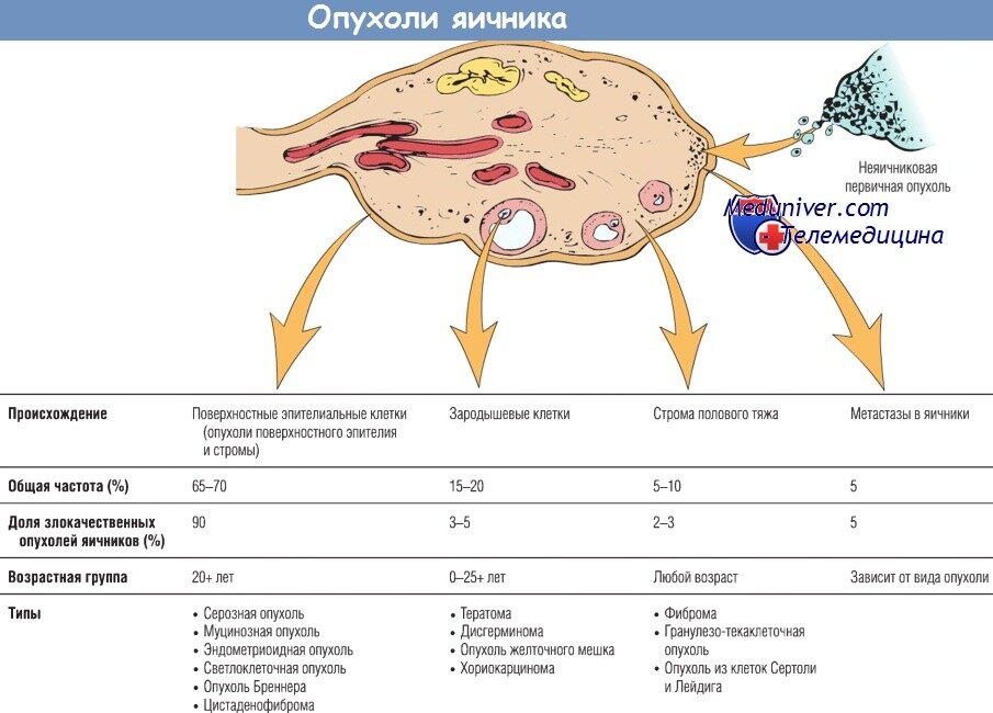 Характерная особенность злокачественных опухолей яичников. Опухоли яичников клинические рекомендации 2021. Злокачественные опухоли яичников первичный вторичный. Классификация опухолей яичников по стадиям.