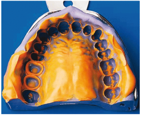 Двойной оттиск верхней челюсти Примерка восковых валиков