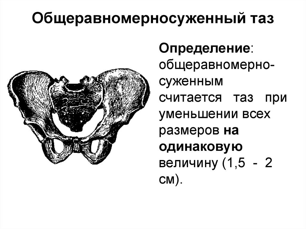Рахитический таз акушерство. Общеравномерносуженный таз размеры. Общеравномерносуженный таз. Механизм родов при общеравномерносуженном тазе. Общеравномерносуженный таз 2 степени.