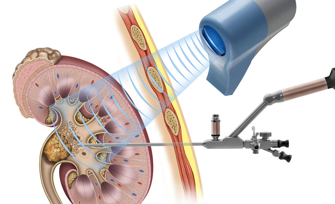 Дробление 2023. Перкутанная чрескожная литотрипсия. Перкутанная нефролитотрипсия. Трансуретральная нефролитотрипсия. Ударно волновая литотрипсия ЖКБ.