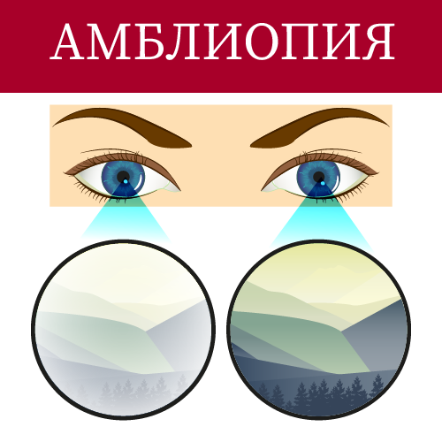 Амблиопия. Причины. Симптомы. Диагностика. Лечение | Медицинский блог ...