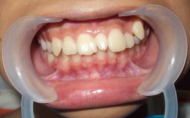 Сверхкомплектные Зубы, Стоматология- ЛюмиДент