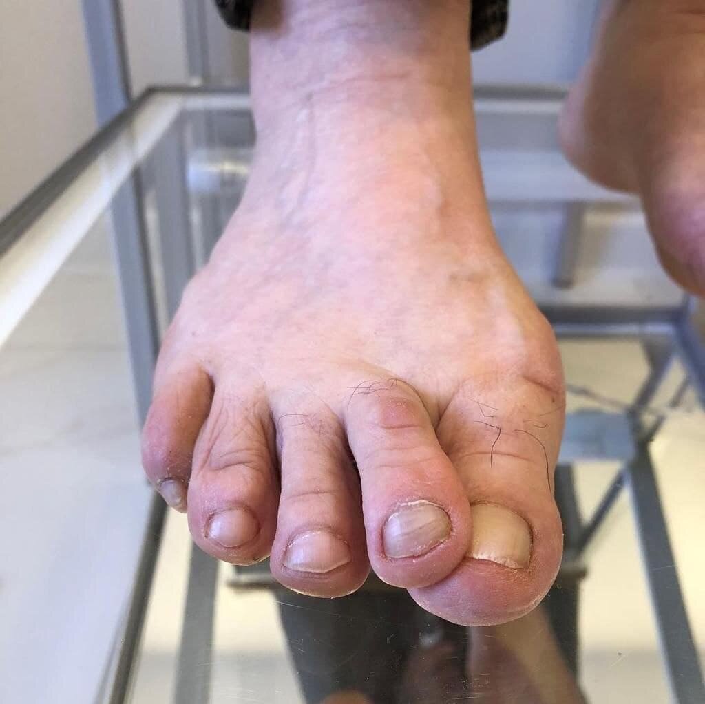 Кроссоверная деформация