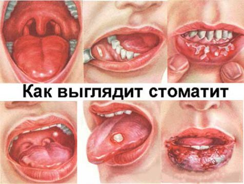 Источник: https://ozubkah.ru 
