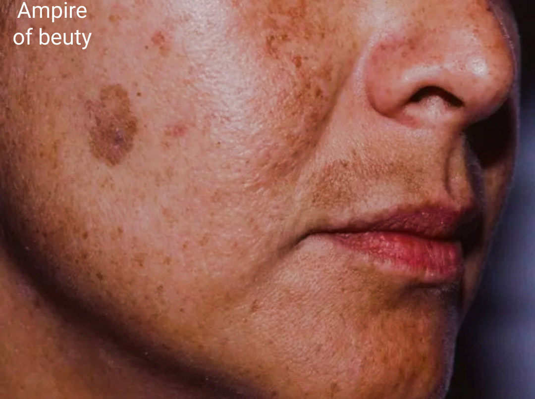 Пигментные пятна 