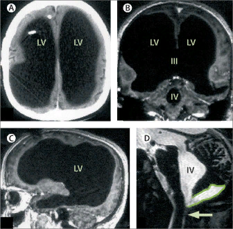 Тёмные области — заполненные жидкостью участки. Feuillet et al./The Lancet.