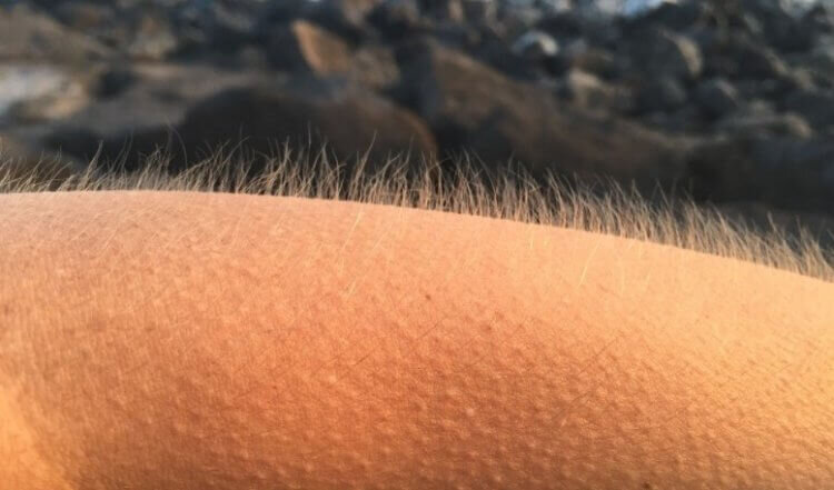 Гусиная кожа выглядит так. Знакомо?