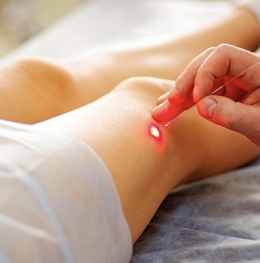 Эндовенозная лазерная коагуляция вен