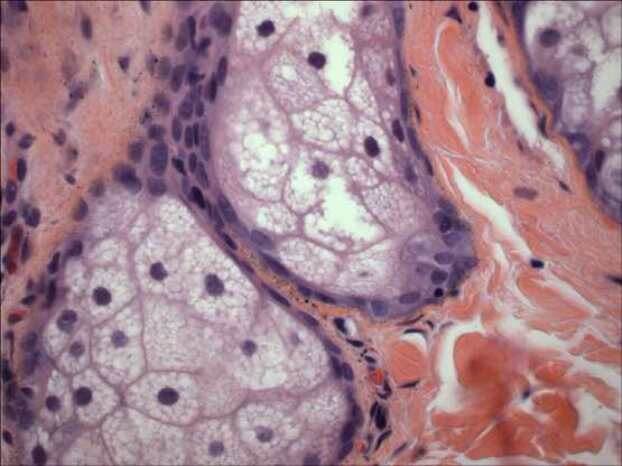 Кожи под микроскопом при отравлении серебром.