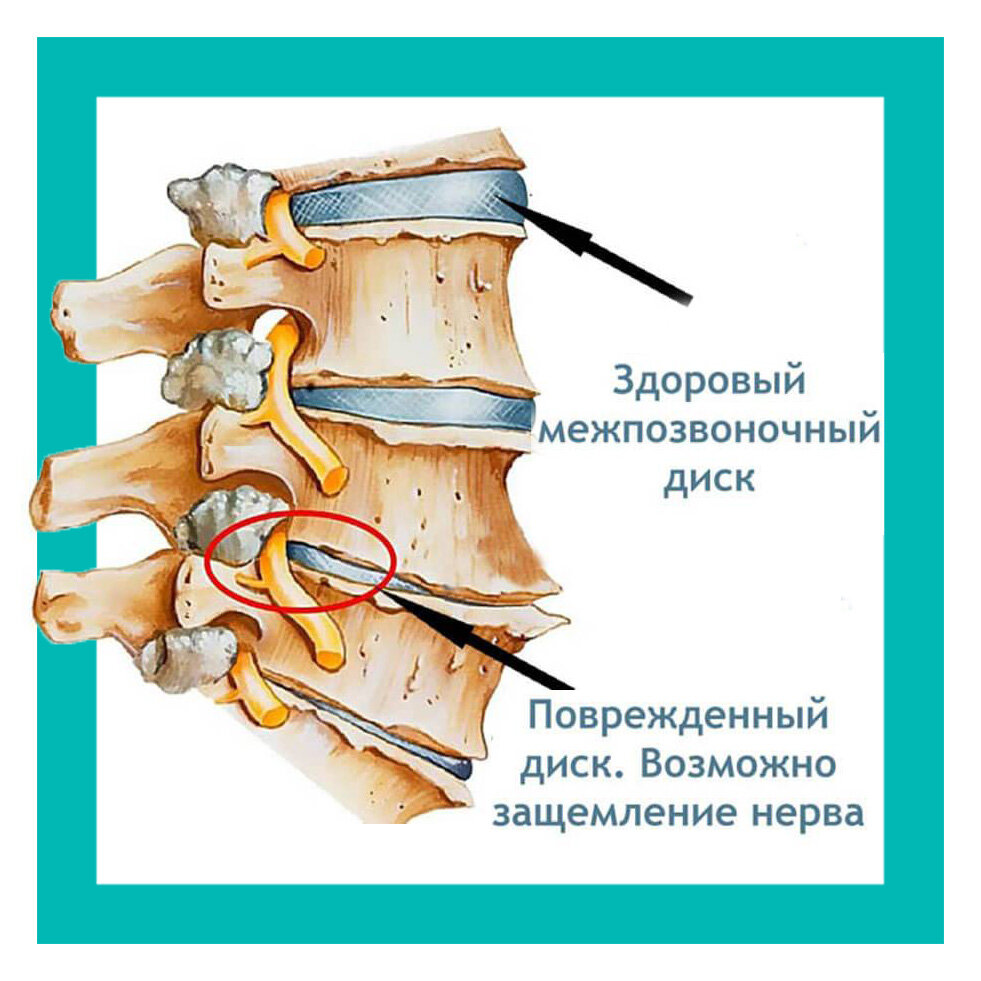 Что делать при защемлении нерва - КВАЛИТЕТ