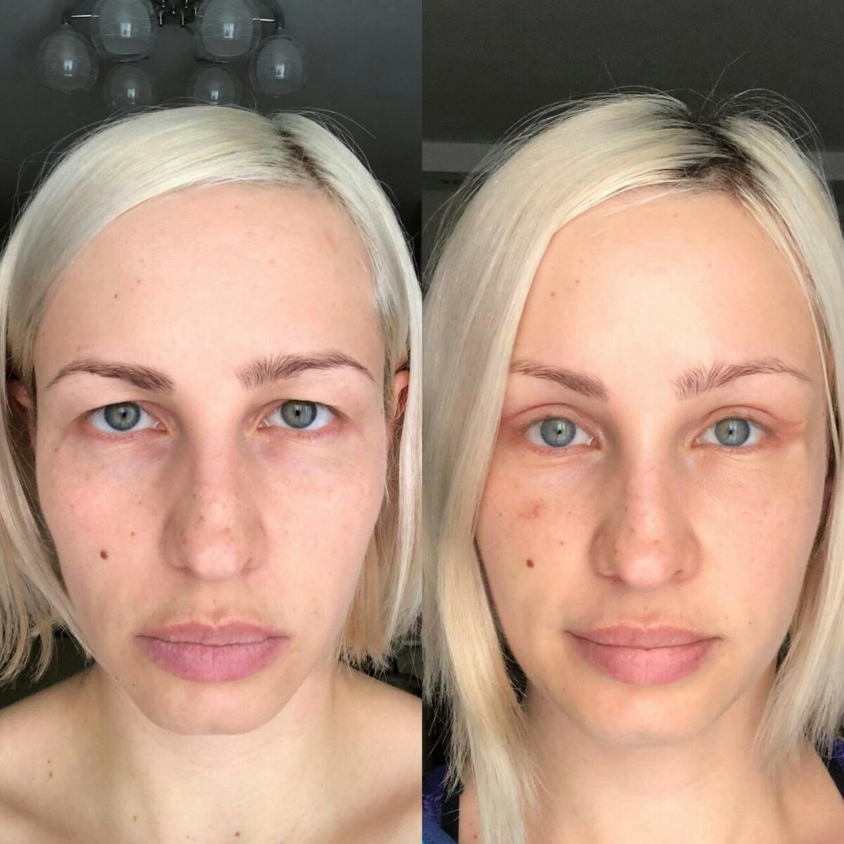 Пациентке выполнена подтяжка лба и верхняя блефаропластика