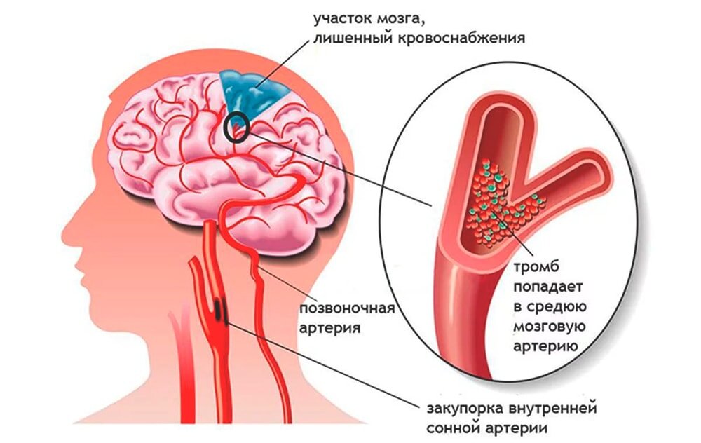 Ишемическая атака головного мозга. Ишемический инсульт сонной артерии. Транзиторная ишемия головного мозга. Ишемический инсульт зоны поражения головного мозга. Тромб в правом