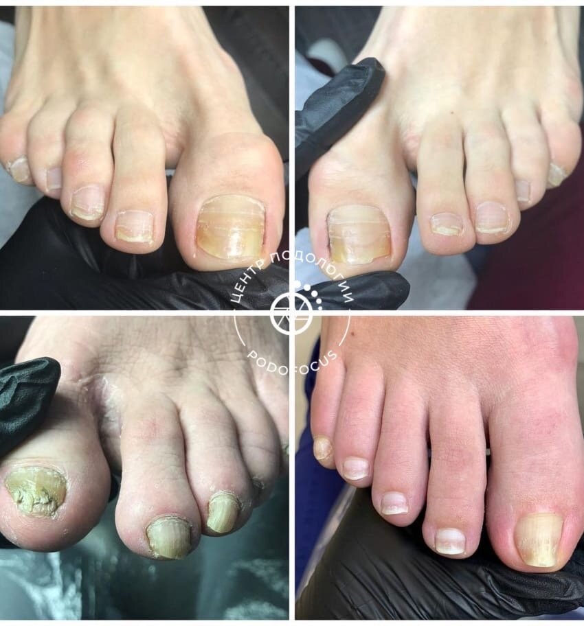 Грибок ногтей, что делать? | Центр подологии №1 PodoFocus | Дзен