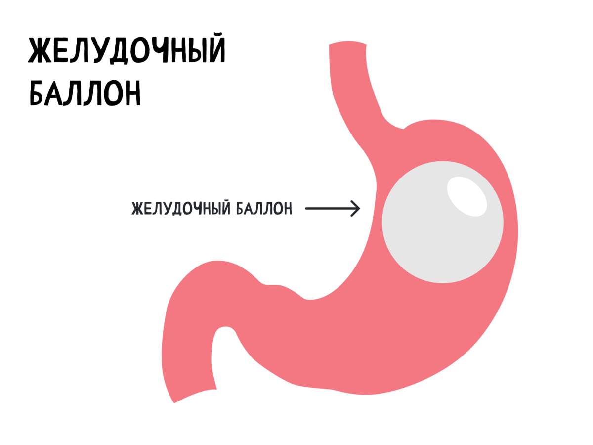 Установка баллона в желудок отзывы. Баллон в желудок для похудения. Извлечение баллона из желудка эндоскопическое. Имплантация баллона в желудок.