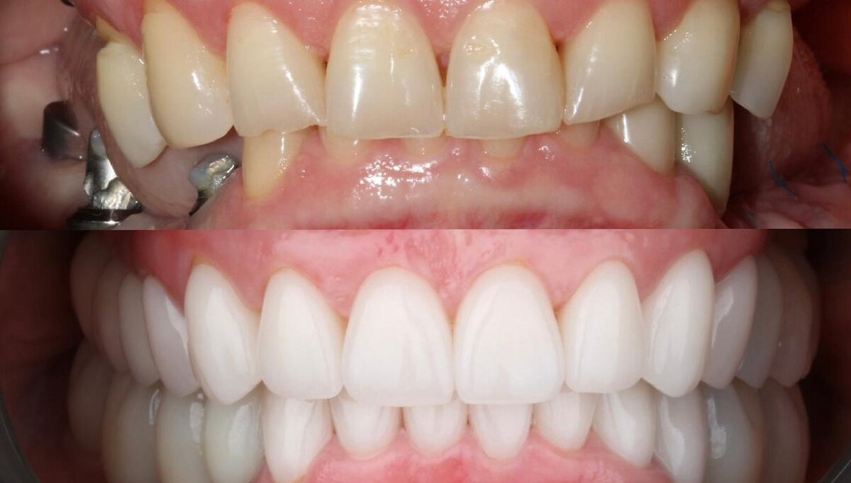 Имплантация и протезирование. Фото “до” и “после”.