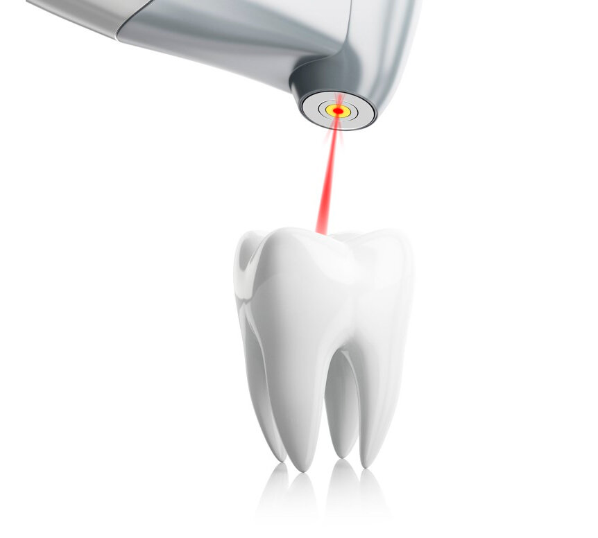 Удаление зуба лазером