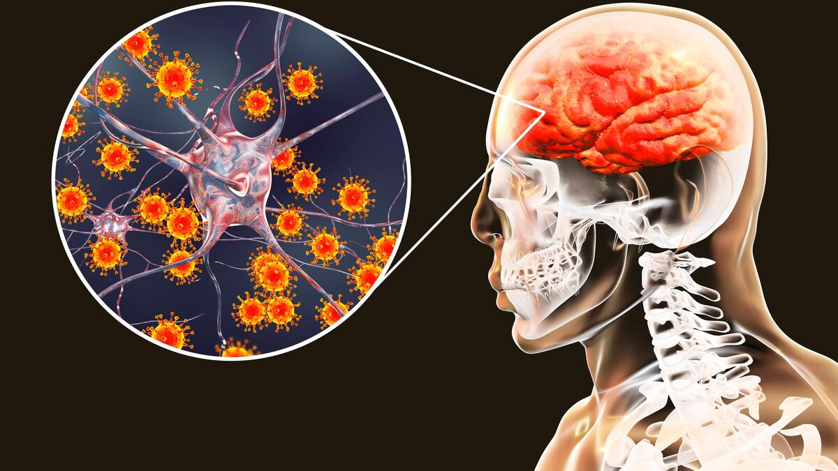 Менингеальная кома возникает как острое осложнение любого инфекционно-воспалительного процесса протекающего в центральной нервной системе.