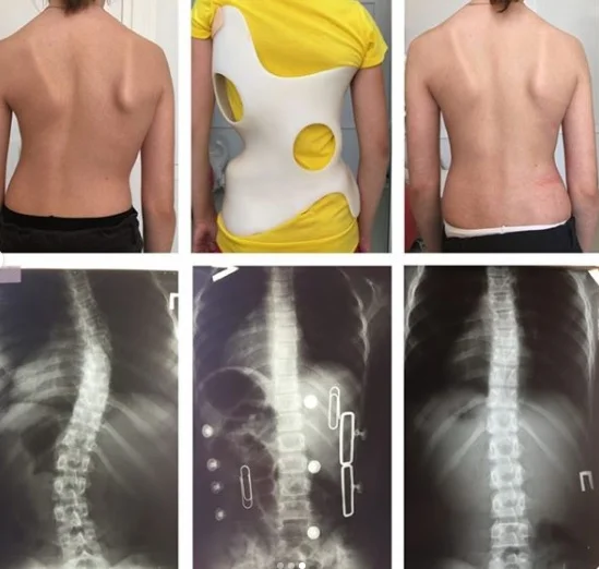 Пример коррекции подросткового сколиоза с использование корсета и специализированных упражнений по методам Шрот и SEAS.