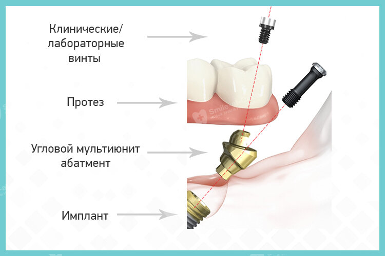 Абатмент на имплант что это. Имплант мультиюнит. Мультиюнит абатмент. Абатмент в стоматологии. Мультиюнет в стоматологии.