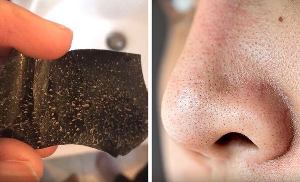 Что вы должны знать, прежде чем использовать чистящие полоски от угрей: неглубокое очищение. Фото: pixabay.com