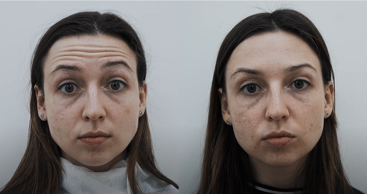 Коррекция мимических морщин