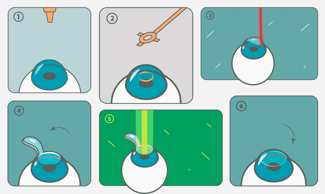 Хочу сделать лазерную коррекцию зрения, но не знаю, какой метод лучше ...