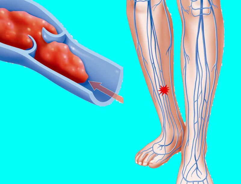 Как узнать есть ли в организме тромбы. Илеофеморальный флеботромбоз. Как узнать есть ли в организме тромбы. Как узнать есть ли в организме тромбы. Симптом хоманса и мозеса.