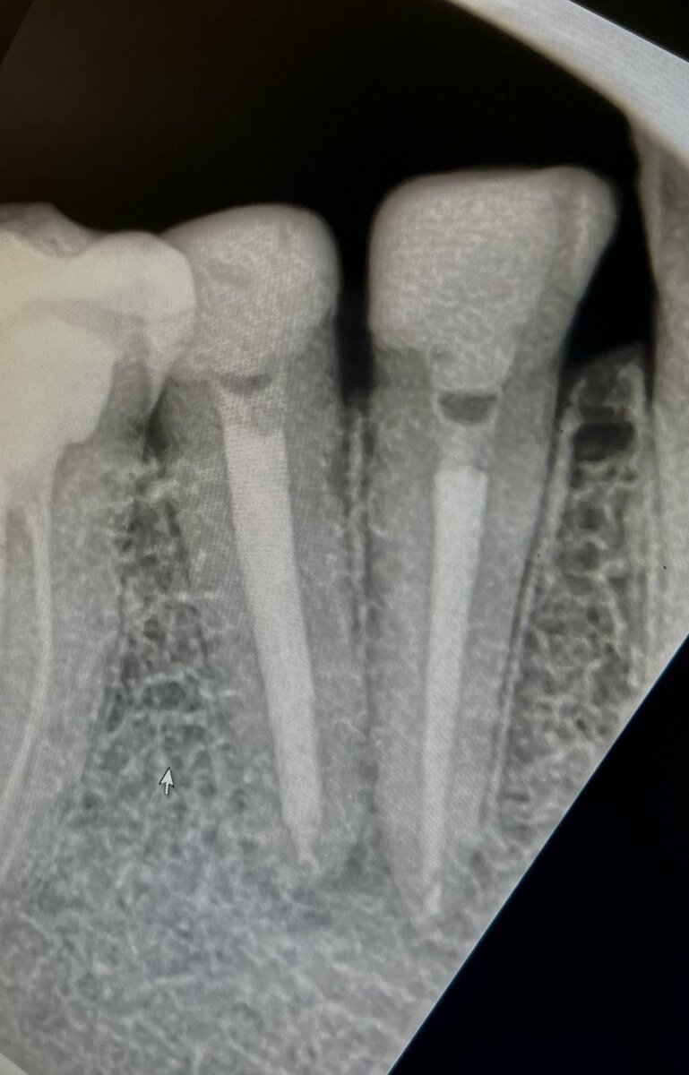 Выведение пломбировочного материала за апекс: эндодонтическая неудача против клинического успеха