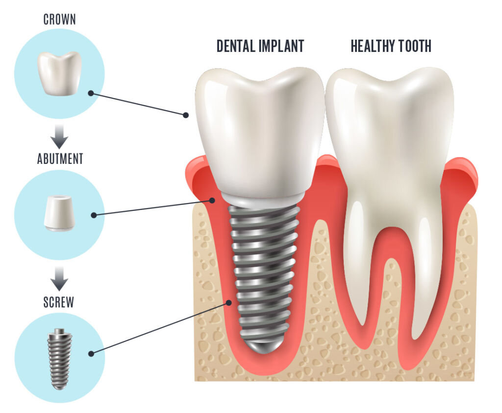 «Новая опасность зубных имплантатов», или Как извратить исследование