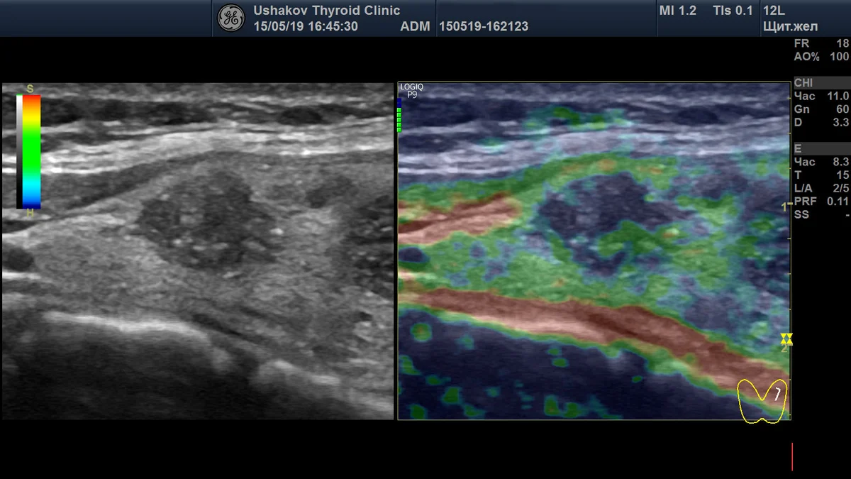 эластография молочных желез что это такое