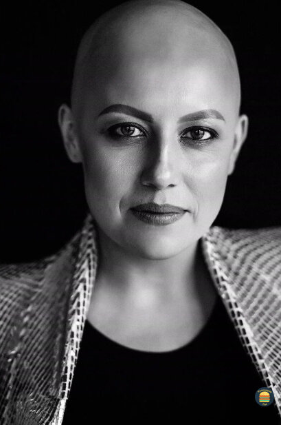 Без волос, лысеющий человек