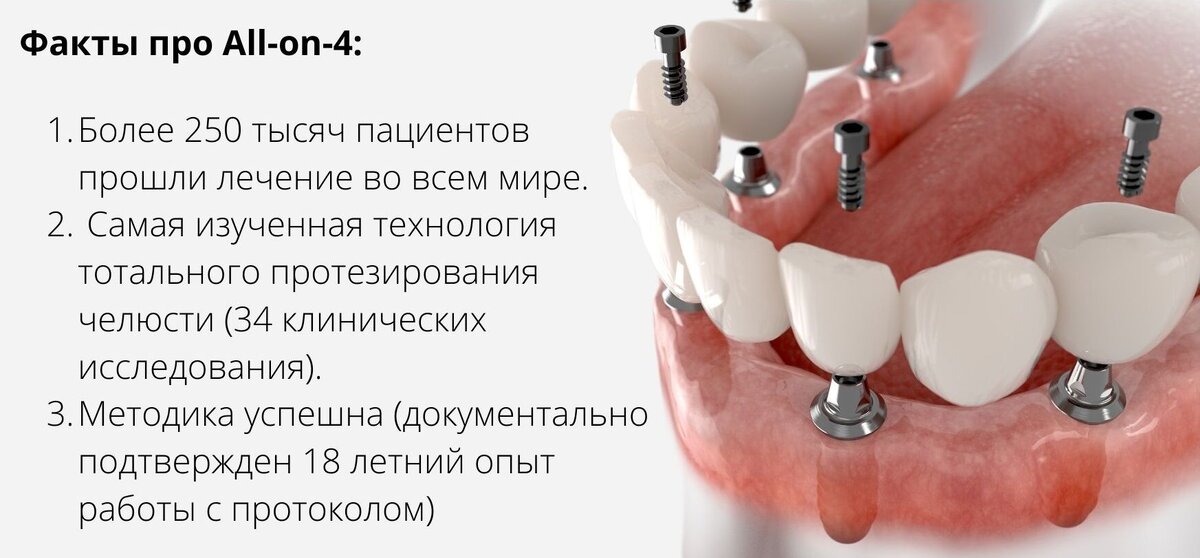 Факты об имплантации Все-на-4