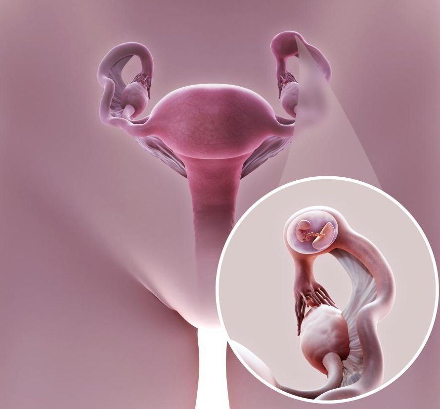 Трубная беременность