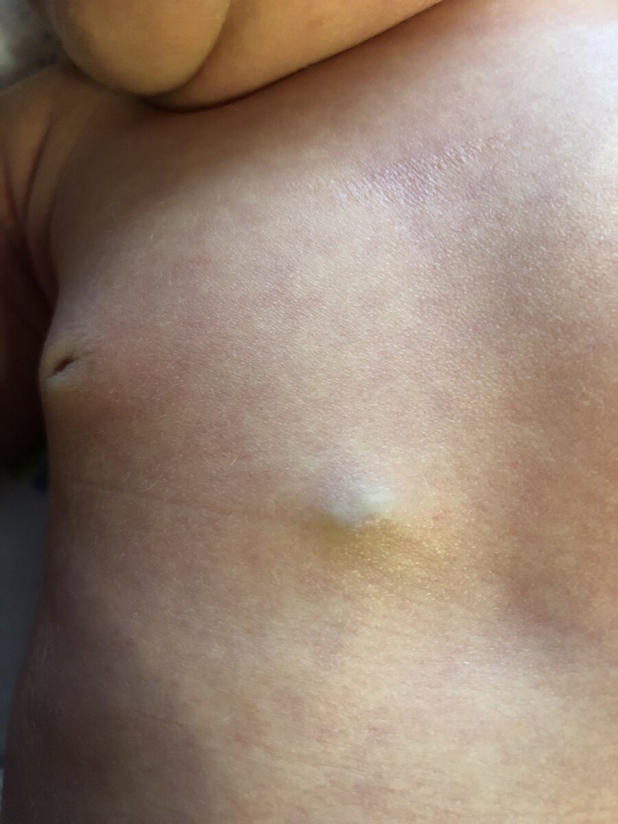 Вот так выглядела гемангиома, когда сыну было 10 дней от роду.