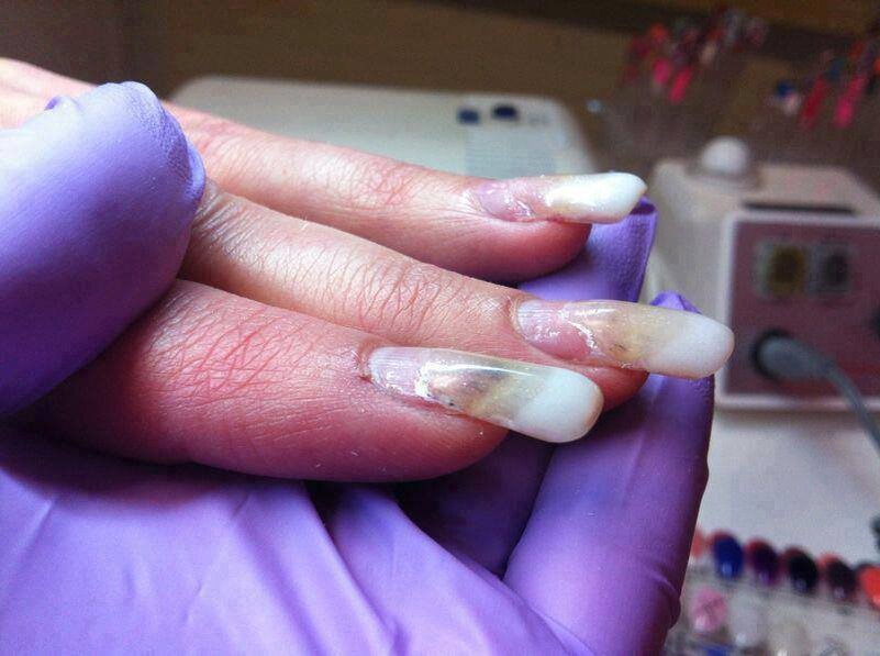 Аллергия у мастера маникюра. Плохой маникюр. Неудачный маникюр. Неправильное наращивание ногтей. Нарощенные ногти под ногтями.