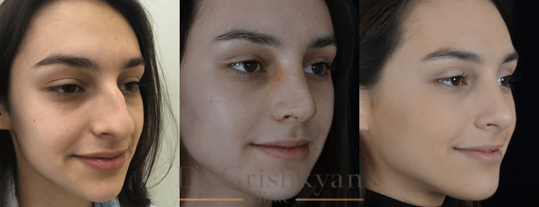 Фотографии пациентки до операции, сразу после снятия гипса и спустя 6 месяцев